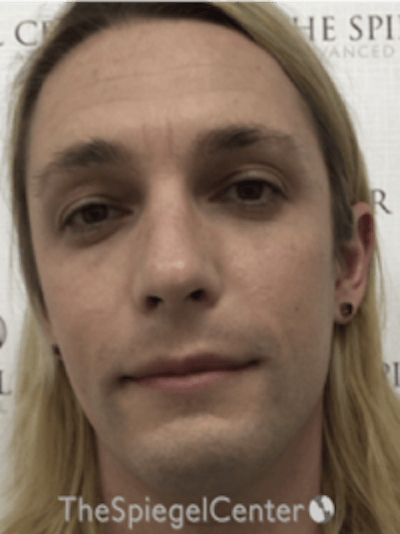 FFS Before & After Gallery - Patient 200068 - Image 1