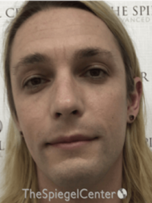 FFS Before & After Gallery - Patient 200068 - Image 1