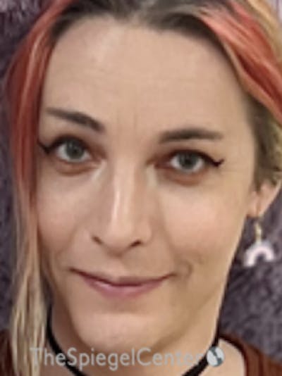 FFS Before & After Gallery - Patient 200068 - Image 2