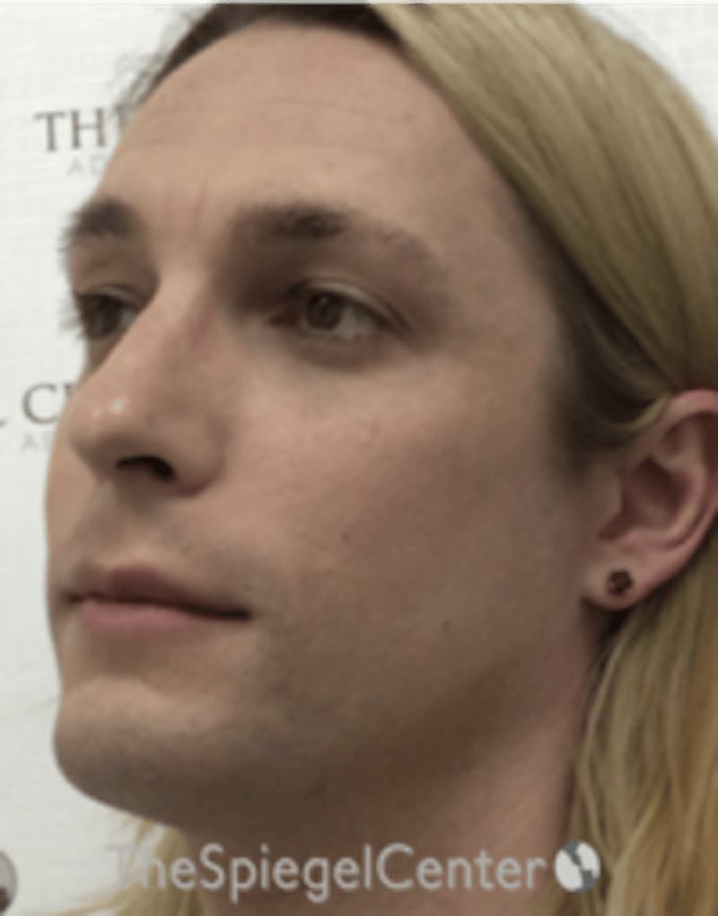 FFS Before & After Gallery - Patient 200068 - Image 3