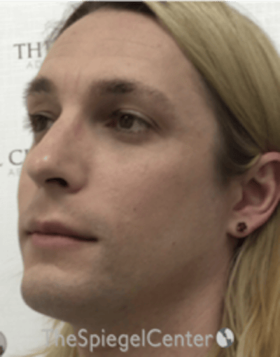 FFS Before & After Gallery - Patient 200068 - Image 3