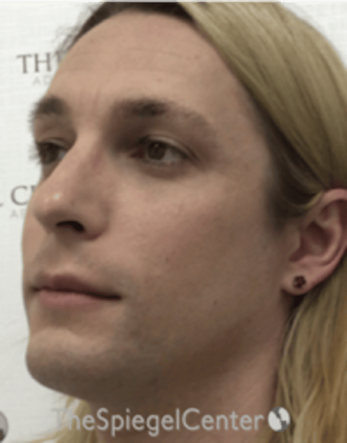 FFS Before & After Gallery - Patient 200068 - Image 3