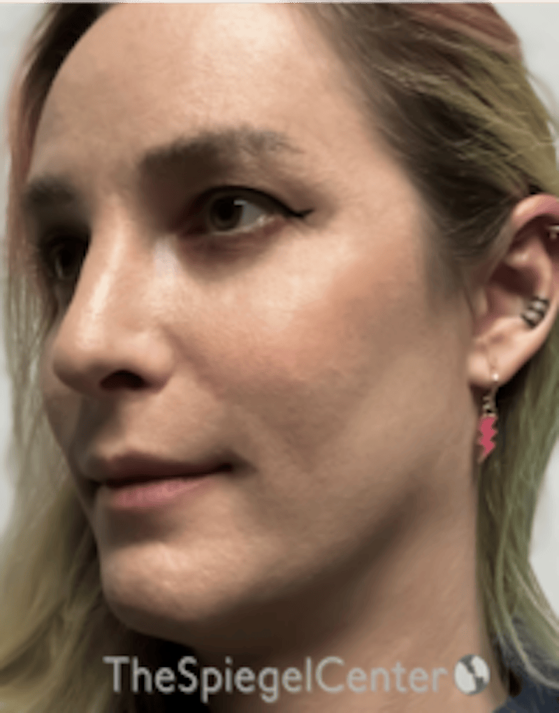 FFS Before & After Gallery - Patient 200068 - Image 4