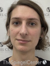 FFS Before & After Gallery - Patient 281581 - Image 1