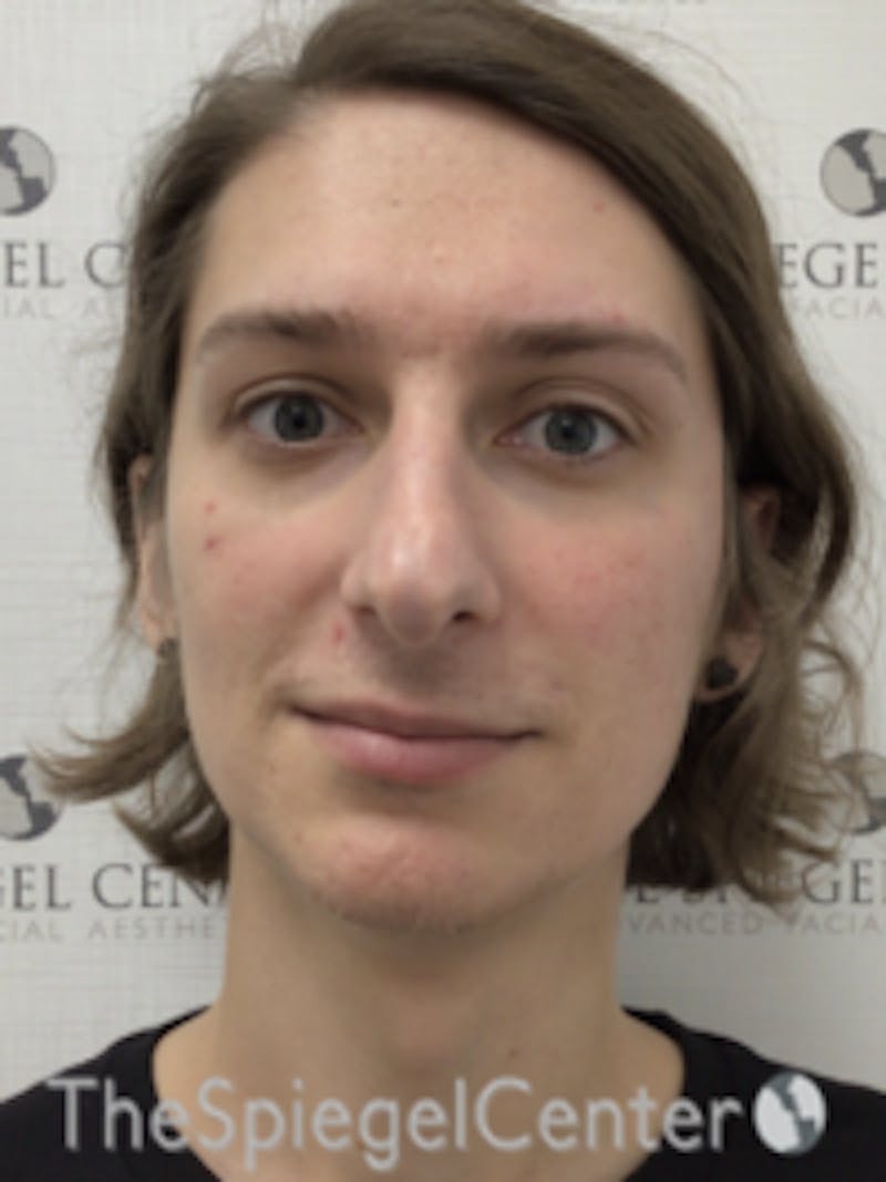 FFS Before & After Gallery - Patient 281581 - Image 1