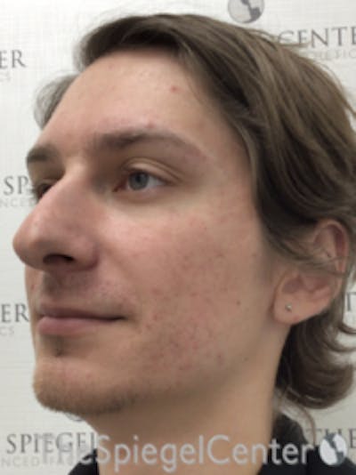 FFS Before & After Gallery - Patient 281581 - Image 3