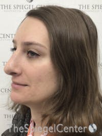 FFS Before & After Gallery - Patient 281581 - Image 4