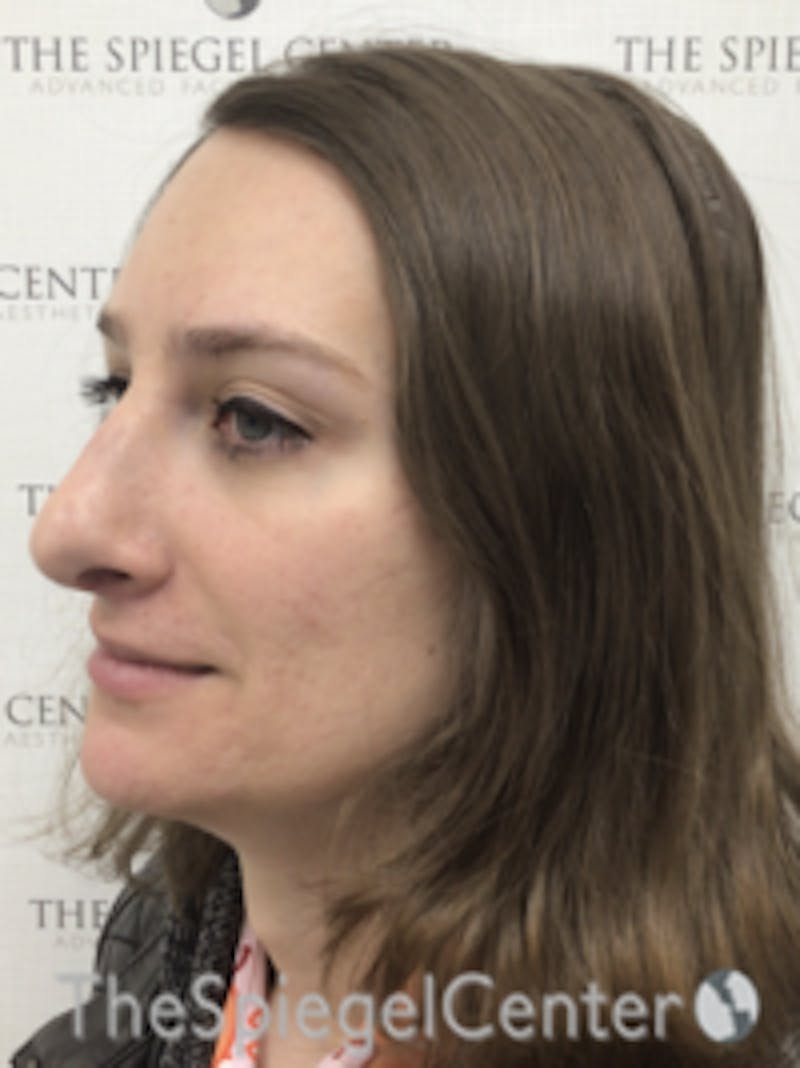 FFS Before & After Gallery - Patient 281581 - Image 4