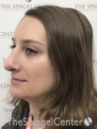 FFS Before & After Gallery - Patient 281581 - Image 4