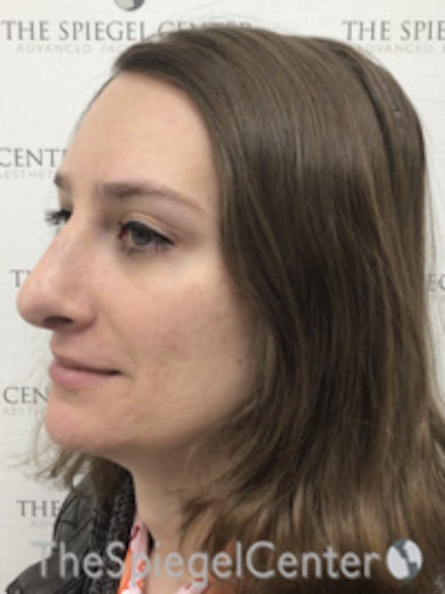 FFS Before & After Gallery - Patient 281581 - Image 4