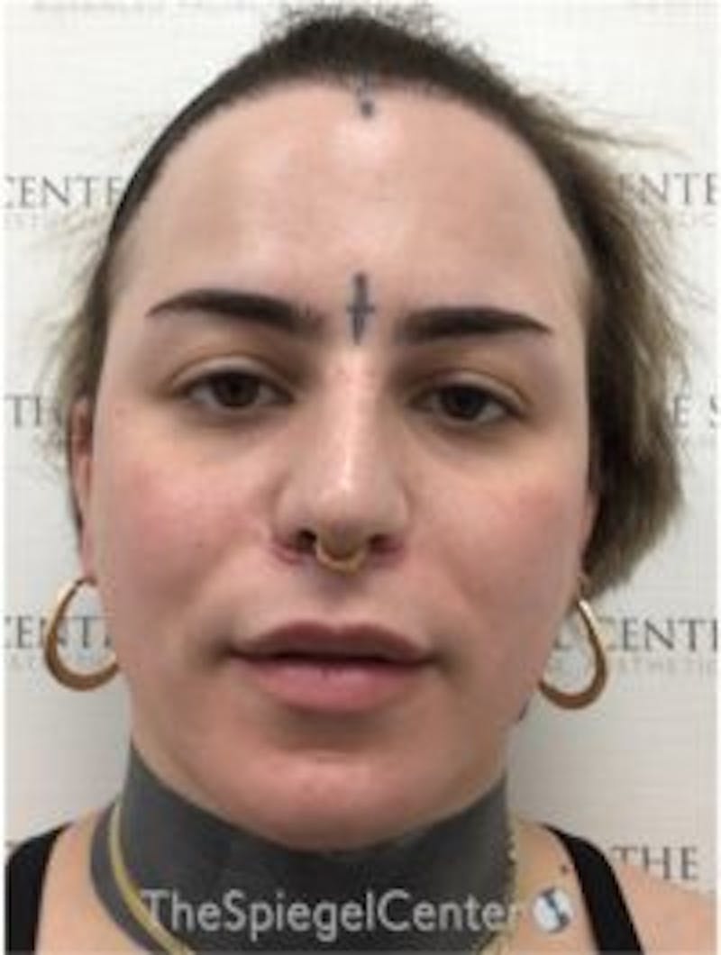 FFS Before & After Gallery - Patient 208654 - Image 2