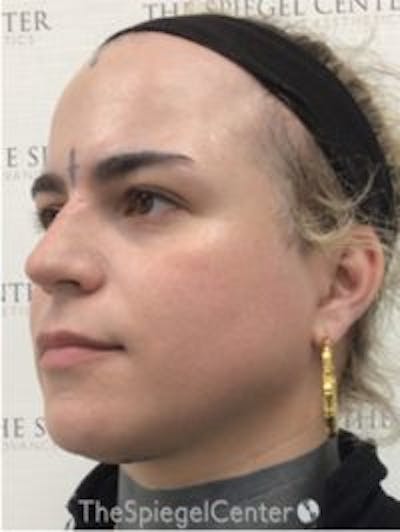 FFS Before & After Gallery - Patient 208654 - Image 3