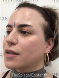 FFS Before & After Gallery - Patient 208654 - Image 4