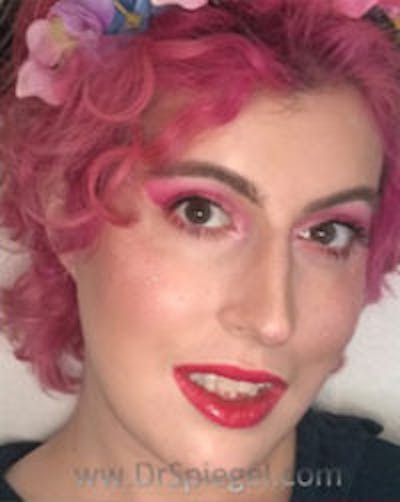 FFS Before & After Gallery - Patient 291159 - Image 2