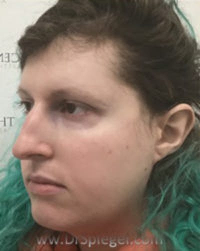 FFS Before & After Gallery - Patient 291159 - Image 3