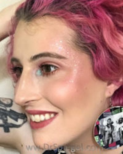 FFS Before & After Gallery - Patient 291159 - Image 4