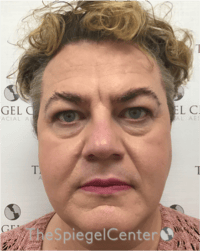 FFS Before & After Gallery - Patient 115914 - Image 1