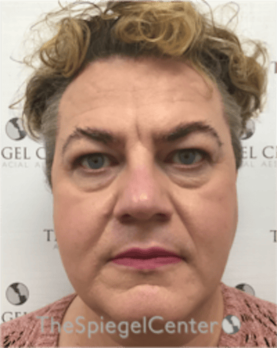 FFS Before & After Gallery - Patient 115914 - Image 1