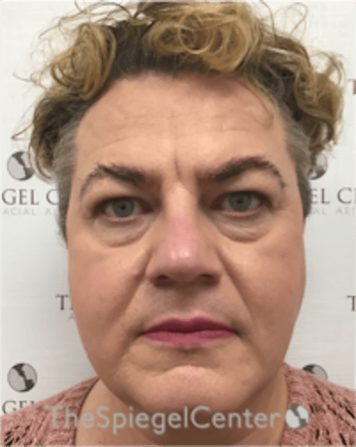 FFS Before & After Gallery - Patient 115914 - Image 1