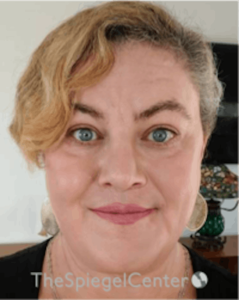 FFS Before & After Gallery - Patient 115914 - Image 2