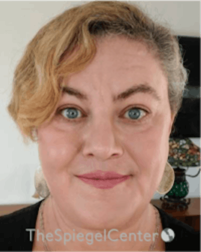 FFS Before & After Gallery - Patient 115914 - Image 2