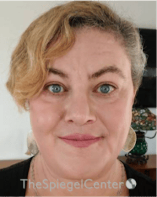 FFS Before & After Gallery - Patient 115914 - Image 2