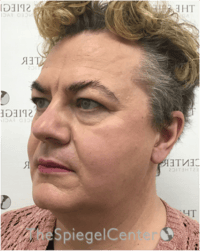 FFS Before & After Gallery - Patient 115914 - Image 3