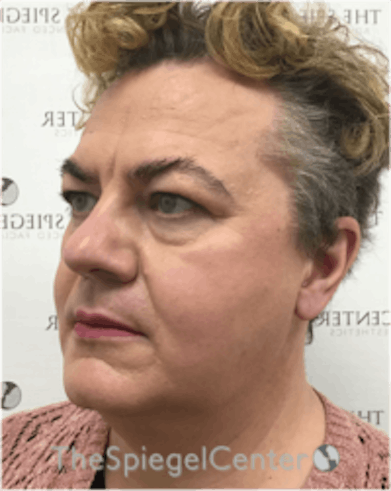 FFS Before & After Gallery - Patient 115914 - Image 3