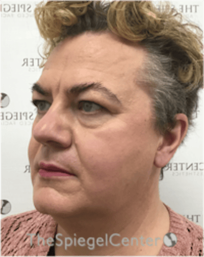 FFS Before & After Gallery - Patient 115914 - Image 3