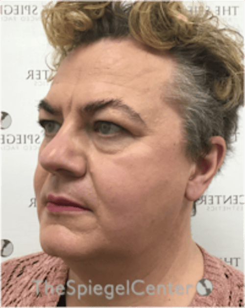 FFS Before & After Gallery - Patient 115914 - Image 3