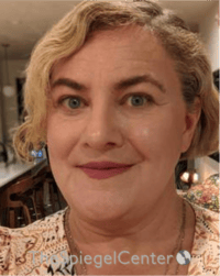 FFS Before & After Gallery - Patient 115914 - Image 4