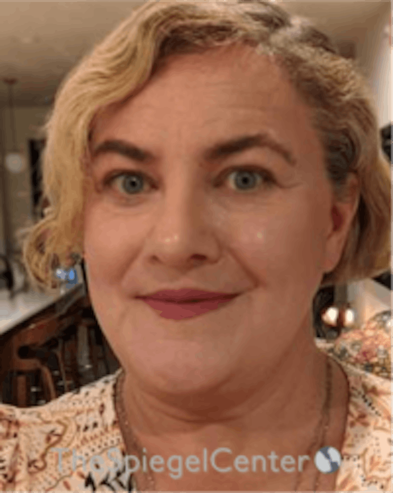 FFS Before & After Gallery - Patient 115914 - Image 4