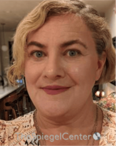 FFS Before & After Gallery - Patient 115914 - Image 4