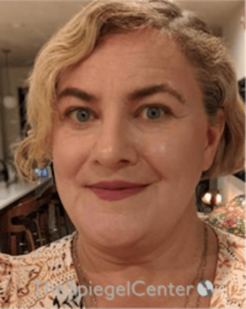 FFS Before & After Gallery - Patient 115914 - Image 4