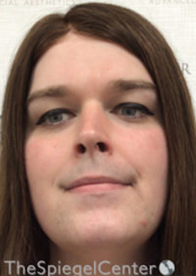 FFS Before & After Gallery - Patient 392835 - Image 1