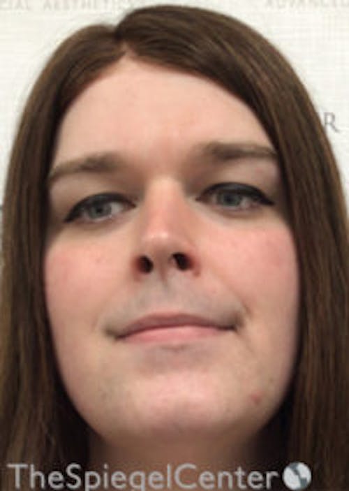 FFS Before & After Gallery - Patient 392835 - Image 1