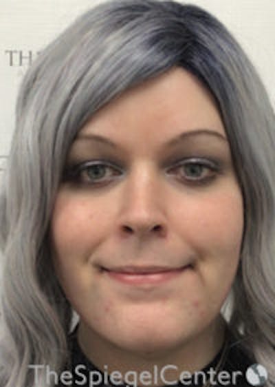 FFS Before & After Gallery - Patient 392835 - Image 2