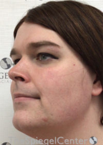 FFS Before & After Gallery - Patient 392835 - Image 3