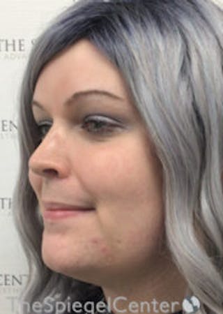 FFS Before & After Gallery - Patient 392835 - Image 4