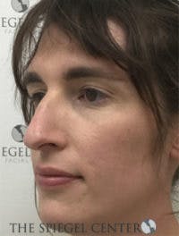 FFS Before & After Gallery - Patient 949979 - Image 3
