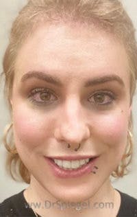 FFS Before & After Gallery - Patient 242513 - Image 2