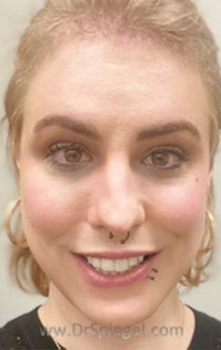 FFS Before & After Gallery - Patient 242513 - Image 2