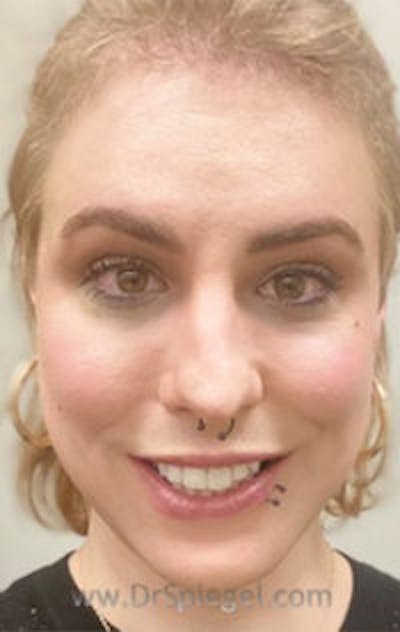 FFS Before & After Gallery - Patient 242513 - Image 2