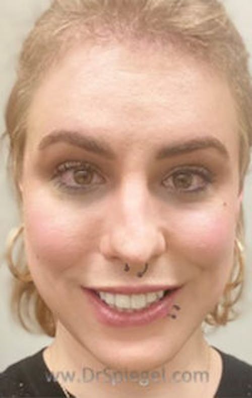 FFS Before & After Gallery - Patient 242513 - Image 2