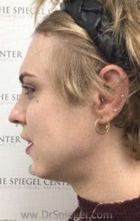 FFS Before & After Gallery - Patient 242513 - Image 3