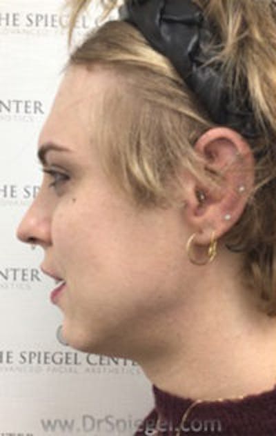 FFS Before & After Gallery - Patient 242513 - Image 3