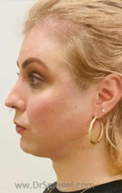 FFS Before & After Gallery - Patient 242513 - Image 4