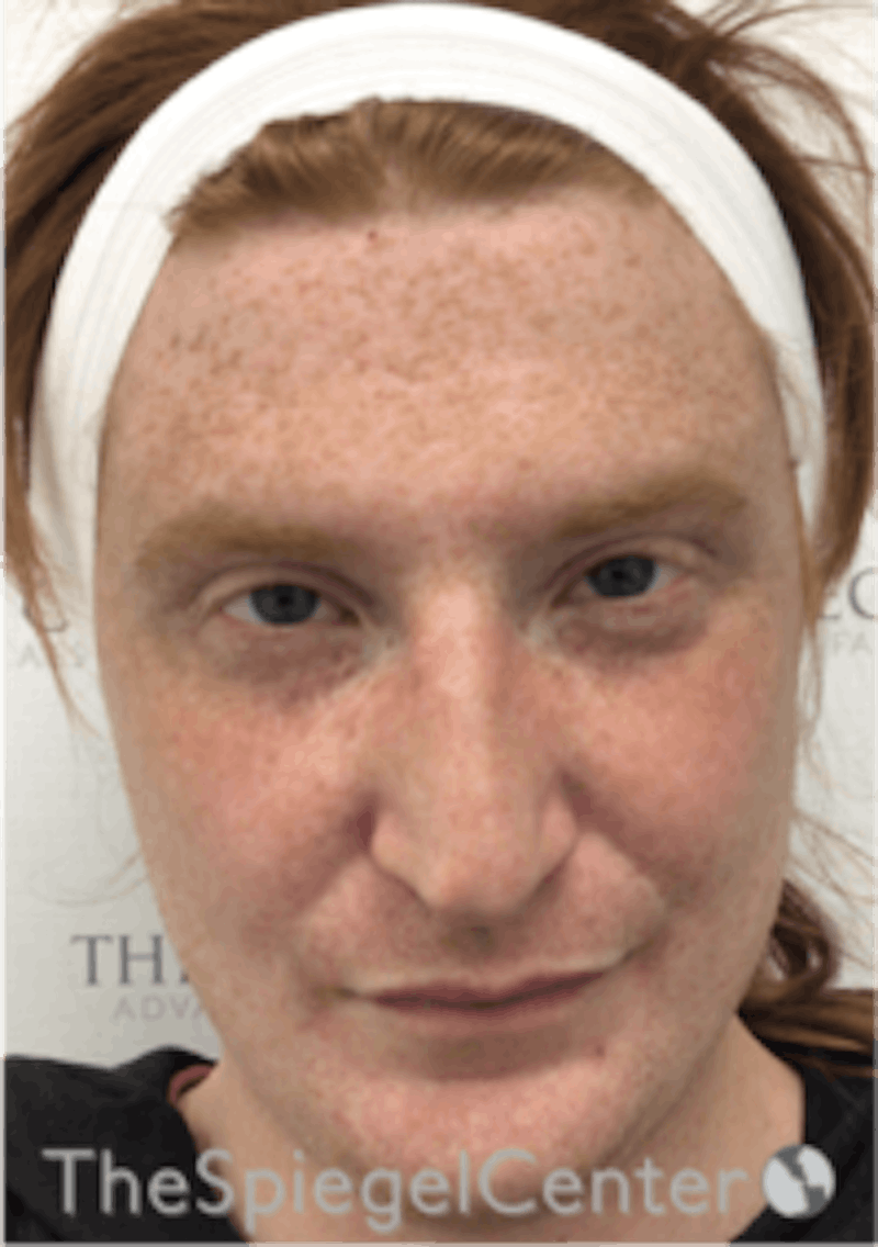 FFS Before & After Gallery - Patient 603948 - Image 1