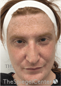 FFS Before & After Gallery - Patient 603948 - Image 1