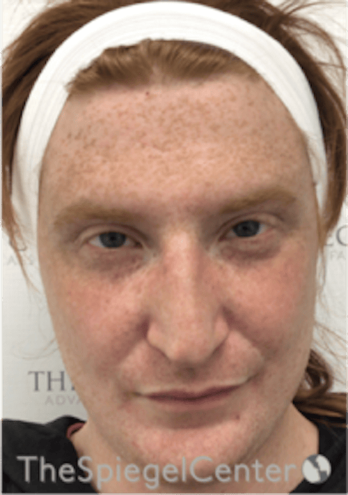 FFS Before & After Gallery - Patient 603948 - Image 1